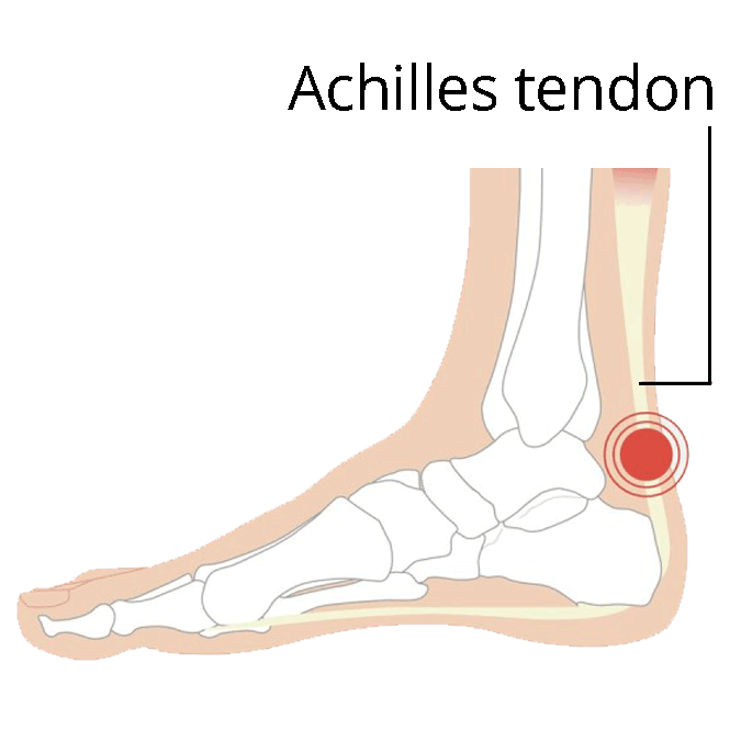 Achilles tendon