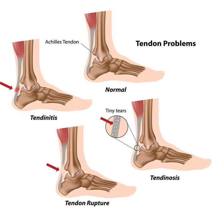 Tendonitis