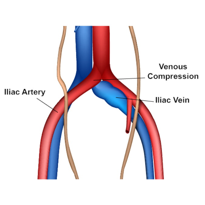 Iliac vein