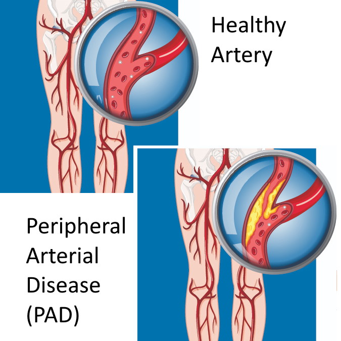 Vascular doctor peripheral arterial disease