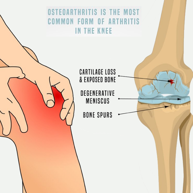 Osteoarthritis Knee Pain 